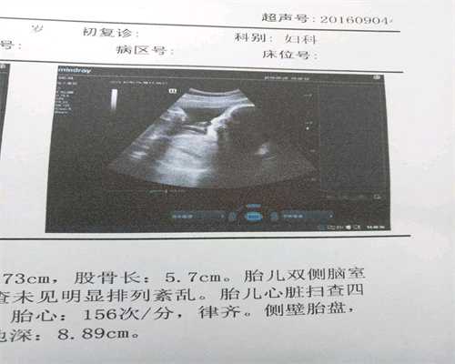 先天性卵巢发育不全最常见的心脏畸形是，孕前